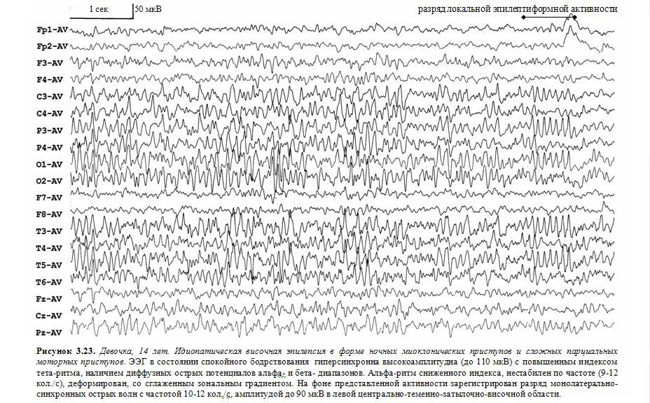 Индекс эпилептиформной активности. Эпилептическая активность на ЭЭГ. ЭЭГ показатели больного эпилепсией. Эпилепсия на ЭЭГ. Альфа ритм ЭЭГ.