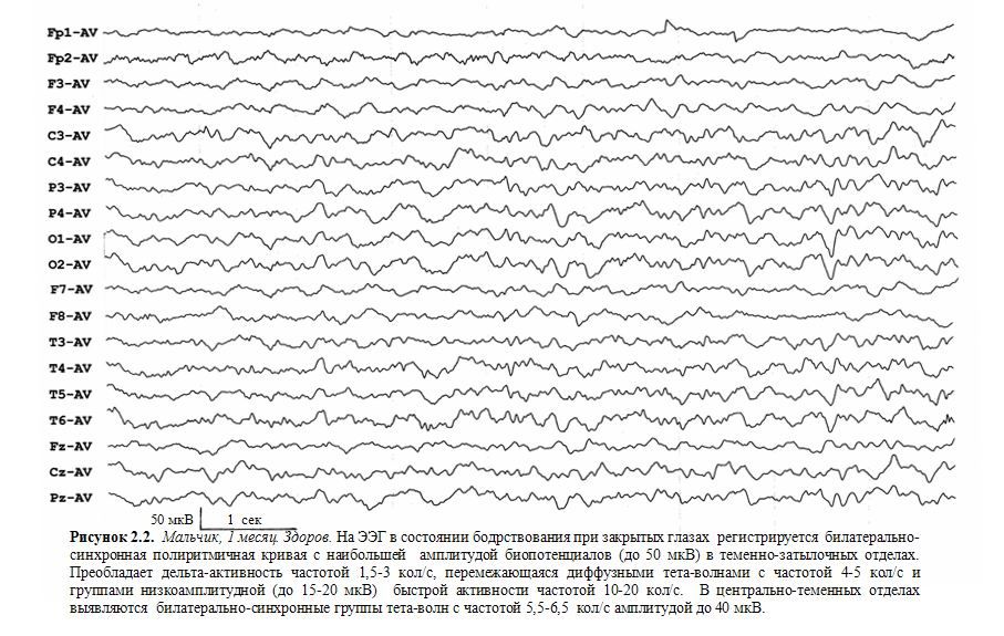 Ээг 6. Нормальная диаграмма ЭЭГ. Эпилепсия на ЭЭГ. Височная эпилепсия на ЭЭГ. ЭЭГ норма и патология у взрослых.