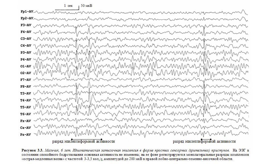 Индекс эпилептиформной активности. Эпилептиформные паттерны на ЭЭГ. Нормальная диаграмма ЭЭГ. Альфа ритм на ЭЭГ У детей норма и нарушения. Вертексные потенциалы на ЭЭГ.
