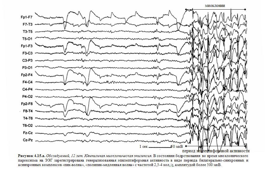 Эпи ээг. Эпилептическая активность на ЭЭГ. Эпилептиформная активность на ЭЭГ У взрослого. Трехфазные волны на ЭЭГ. Синдром Отахара на ЭЭГ.
