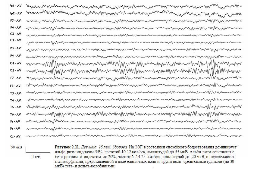 Здоровая ээг. Как выглядит ЭЭГ здорового человека. Эпилептиформная активность на ЭЭГ. ЭЭГ головного мозга здорового человека график. Как выглядит ЭЭГ У здорового ребенка.