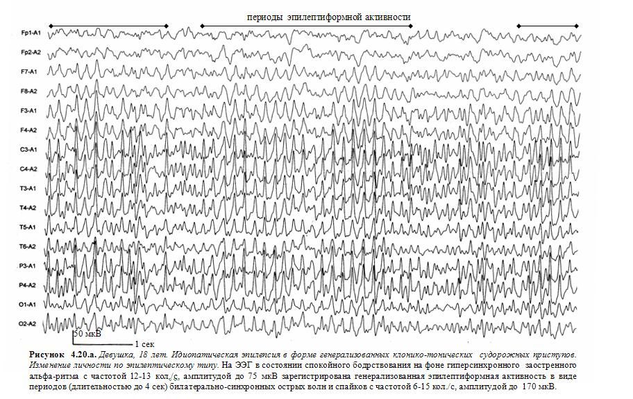 Индекс эпилептиформной активности. ЭЭГ заключение эпилептиформная активность. Эпилептиформные паттерны на ЭЭГ. ЭЭГ эпилепсия пик-волна. Эпилептиформная активность на ЭЭГ У ребенка что это.
