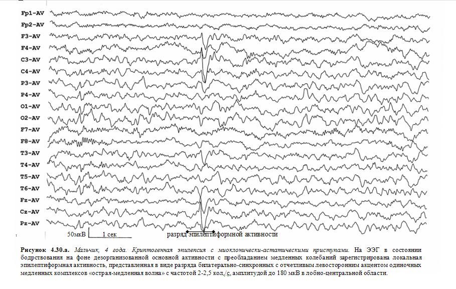Умеренные изменения бэа головного. Индекс эпилептиформной активности. Диффузная эпилептиформная активность. Комплекс электроэнцефалографический "МБН 20". Какой год.