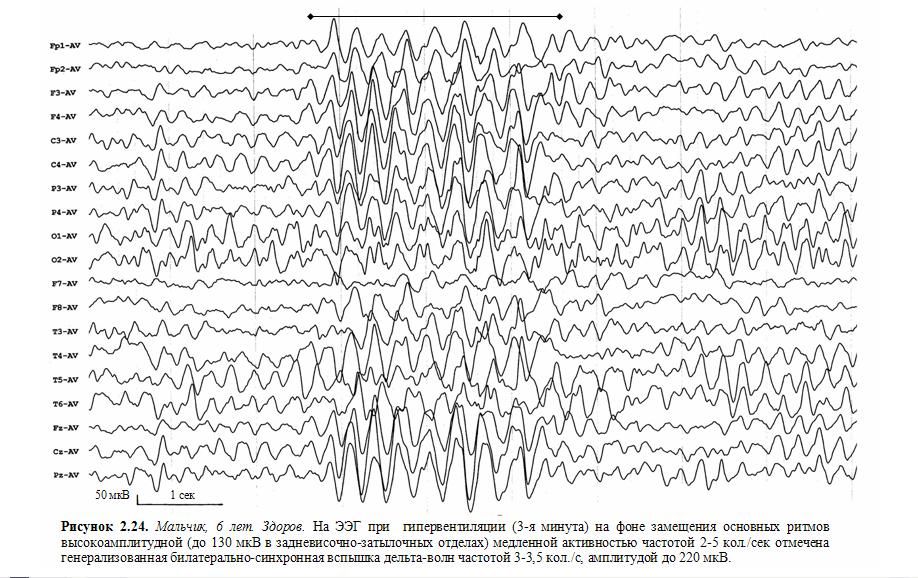 Ээг индексы. Нормальная диаграмма ЭЭГ. Электроэнцефалография головного мозга (ЭЭГ). ЭЭГ головного мозга показатели. Энцефалограмма головы нормальные показатели.