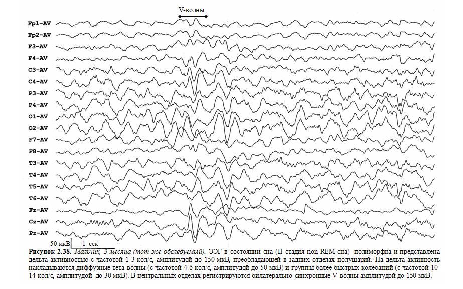 Срок ээг. Эпилептиформные феномены на ЭЭГ что это. Эпилептиформная активность на ЭЭГ. Вертексные потенциалы на ЭЭГ. Эпилептический статус ЭЭГ.