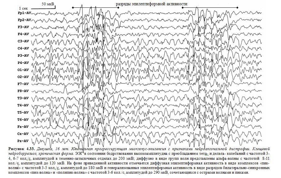 Индекс эпилептиформной активности. Эпилептиформная активность на ЭЭГ. Эпилептиформные паттерны на ЭЭГ. ЭЭГ эпилепсия пик-волна. Эпилептиформная активность на ЭЭГ У ребенка что это.