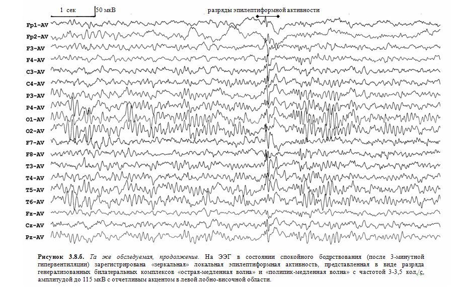 Эпи ээг. Эпилептиформные паттерны на ЭЭГ. Эпилептическая активность на ЭЭГ. Региональная эпилептиформная активность ЭЭГ. Острые волны на ЭЭГ.