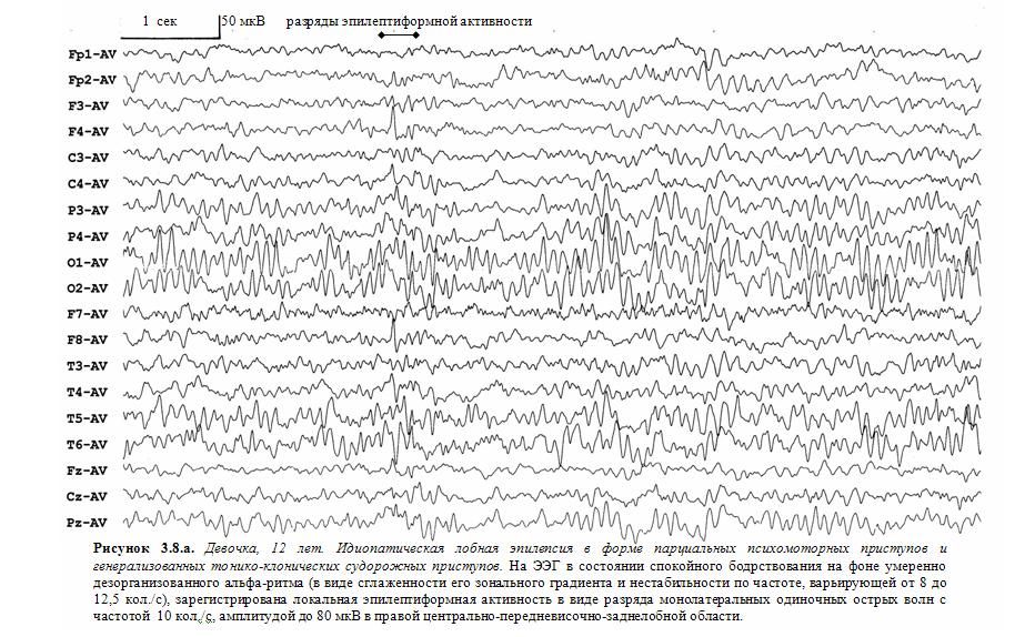 Индекс эпилептиформной активности. Эпилептиформные паттерны на ЭЭГ. Абсанс эпилепсия ЭЭГ. Эпилептиформные феномены на ЭЭГ что это. Острые волны на ЭЭГ.