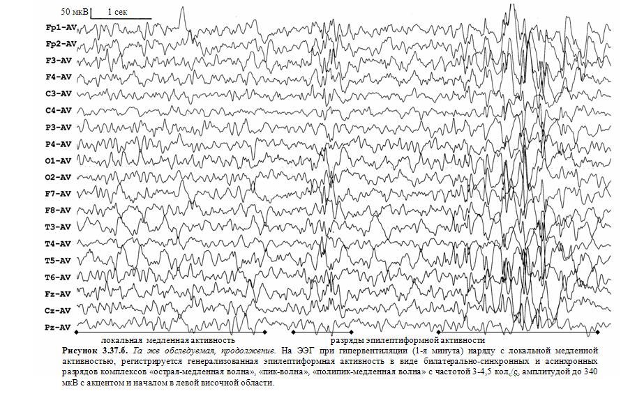 Плохое ээг. Комплекс Спайк медленная волна на ЭЭГ. Пик волна на ЭЭГ. ЭЭГ эпилепсия пик-волна. Эпилептиформная активность на ЭЭГ.
