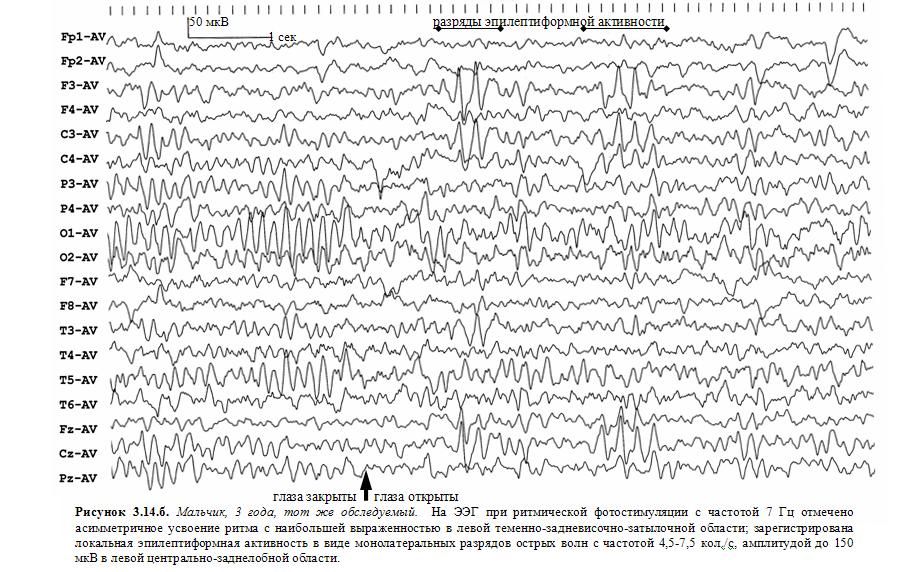 Индекс эпилептиформной активности. Эпилептиформная активность на ЭЭГ. Эпилептиформные феномены на ЭЭГ что это. Синдром Ретта ЭЭГ. Тонический приступ ЭЭГ паттерн.