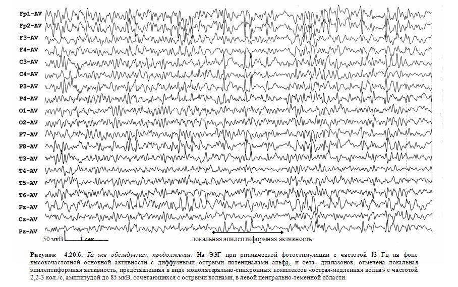 Индекс эпилептиформной активности. Комплекс острая волна медленная волна на ЭЭГ. К-комплексы на ЭЭГ. Изменения на ЭЭГ при умственной отсталости. Эпилептиформные элементы.
